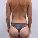 Бодилифт с липомоделированием - после