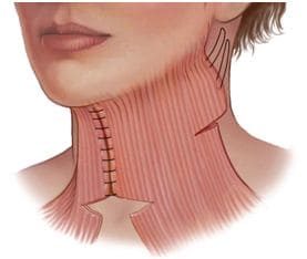 Иллюстрация латеральная платизмопластика