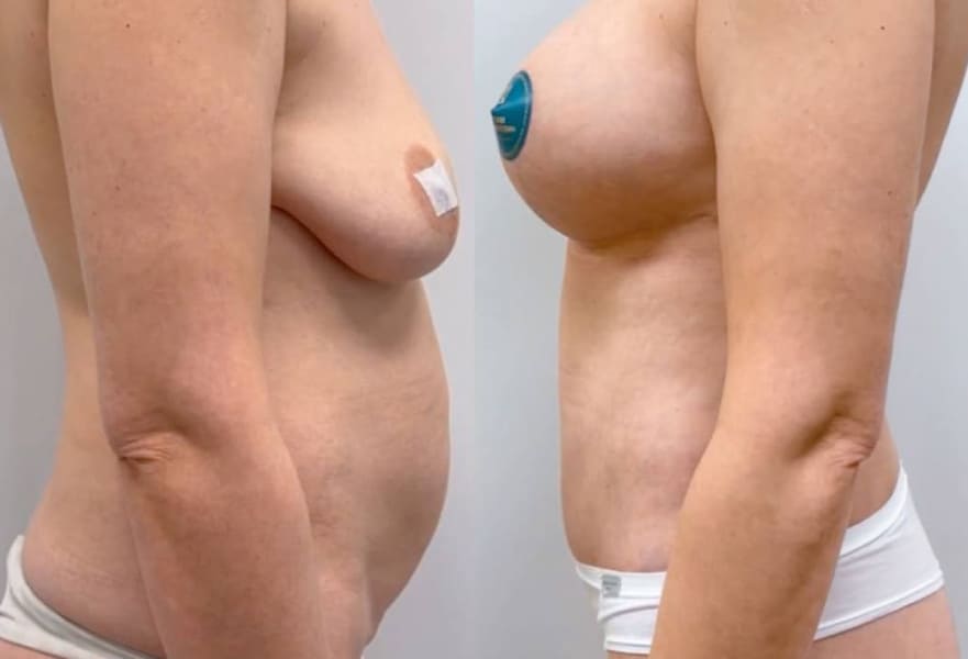 Подтяжка с имплантацией и бодилифт. Вид сбоку. Халилуллин Р.И.