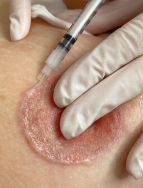 Пример ухода за рубцами. Хирург Халилуллин Р.И.