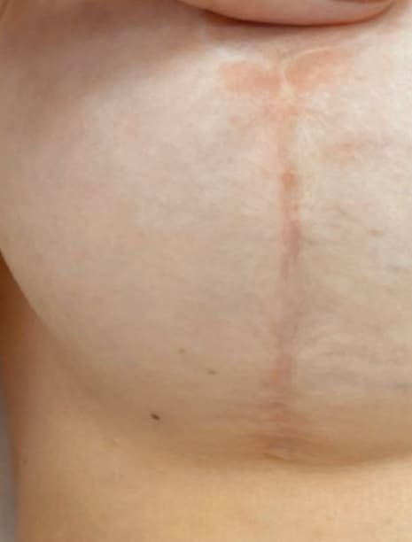 Пример рубцов при маммопластике. Хирург Халилуллин Р.И.