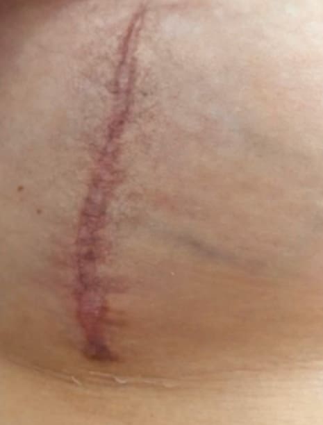 Пример рубцевания ткани при маммопластике. Хирург Халилуллин Р.И.