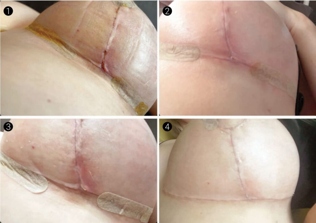 Пример рубцов. Работа пластического хирурга Халилуллина Р.И.