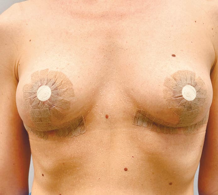 Пример наклеенных стрипов - Хирург Халилуллин Р.И.