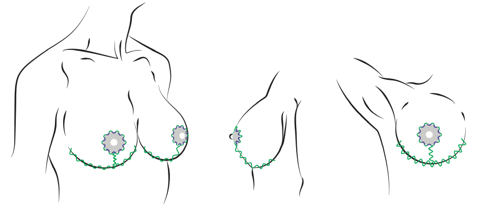 Т-образная подтяжка груди. Хирург Халилуллин Р.И.